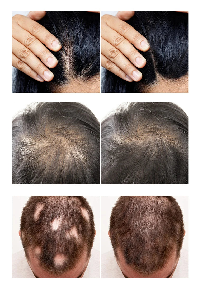 2024 Hair Loss Therapy Laser Led Infrared Light Hair Growth System Device for Hair Growth