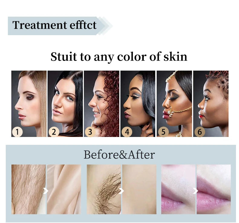 2022 Factory Price 3 Wavelength 1800w Big Handle Power 755 808 1064 808nm Diode Laser Hair Removal